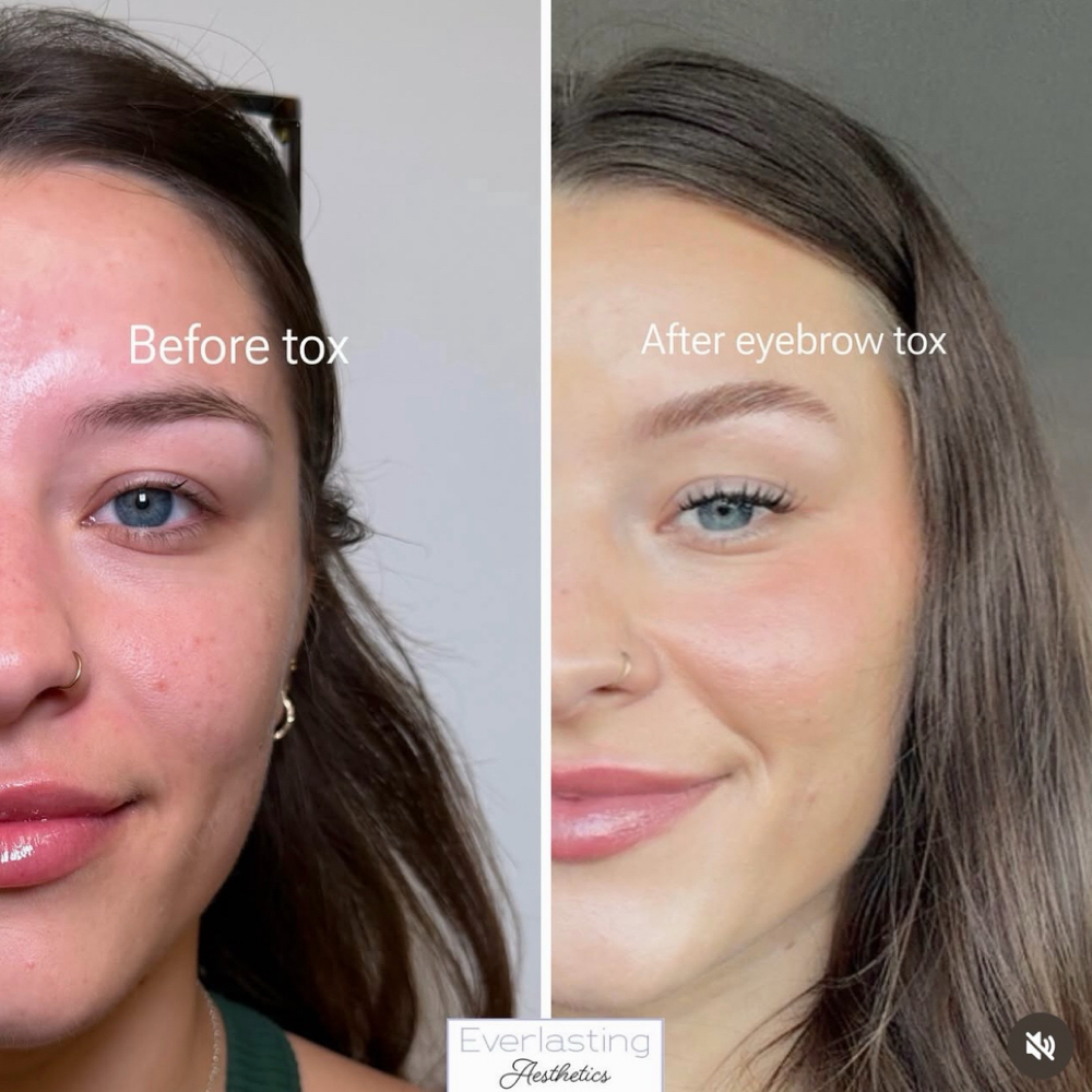 The Brow Lift Treatment at Everlasting Aesthetics LLC in Surprise, AZ