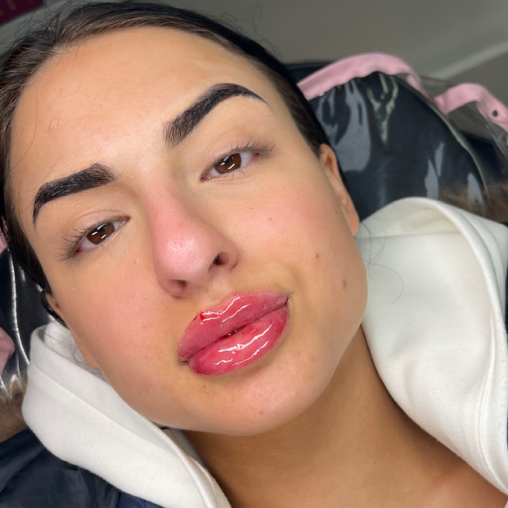 Russian Lip 1mL at Sevrae Aesthetics in College Park, GA