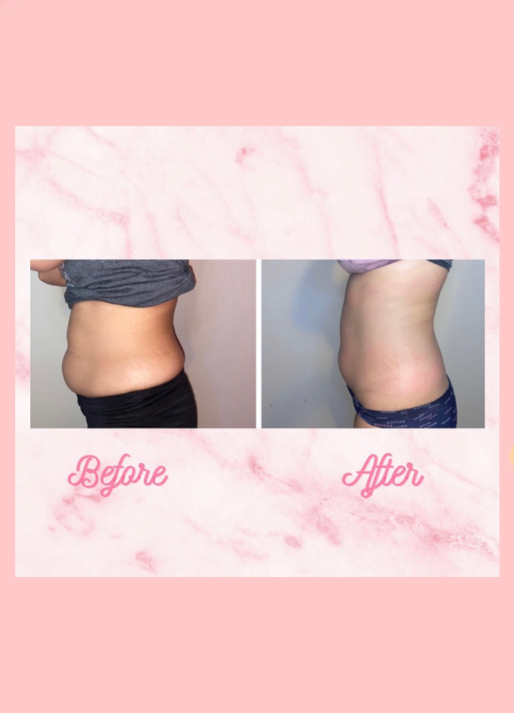 Abdomen & Love Handle Bodysculpting