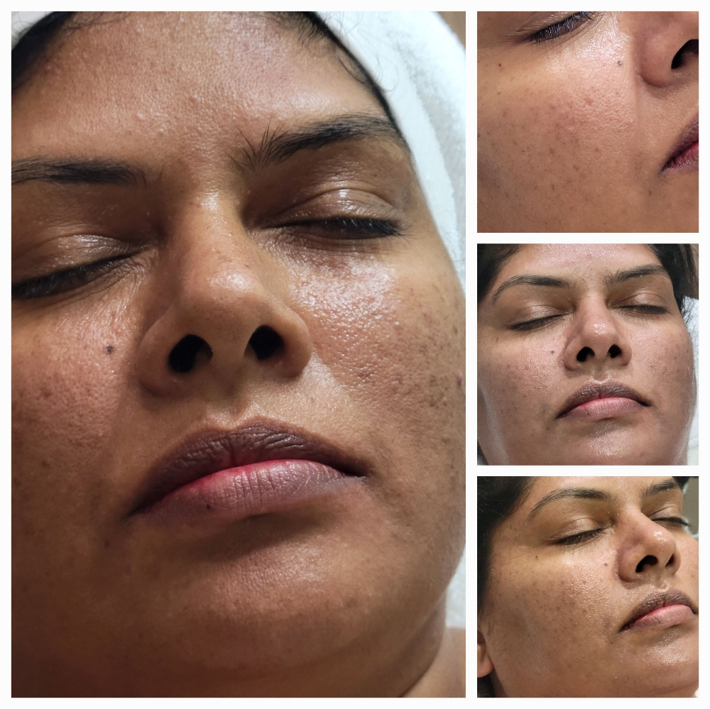 HydroDermabrasion Facial