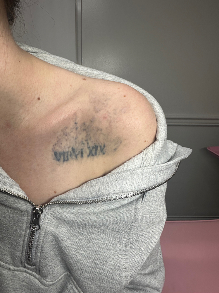 Saline Tattoo Removal