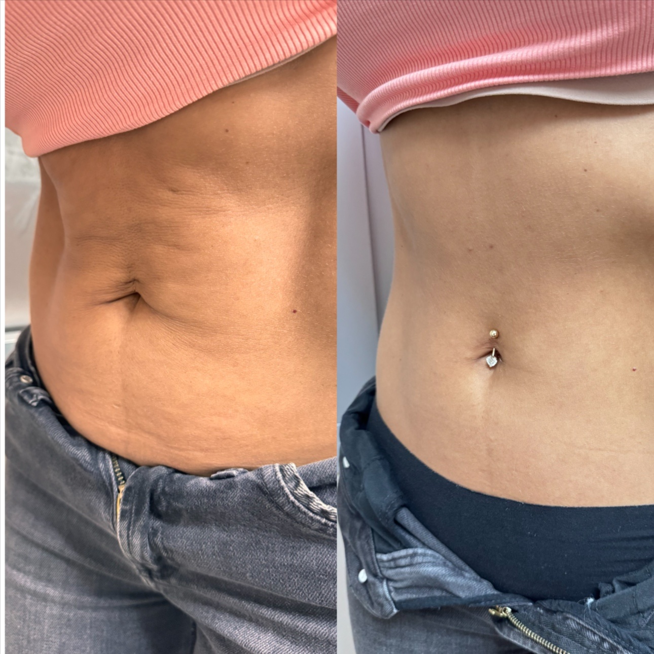 Body Cavitation + RF at Eula Skin in Dallas, TX