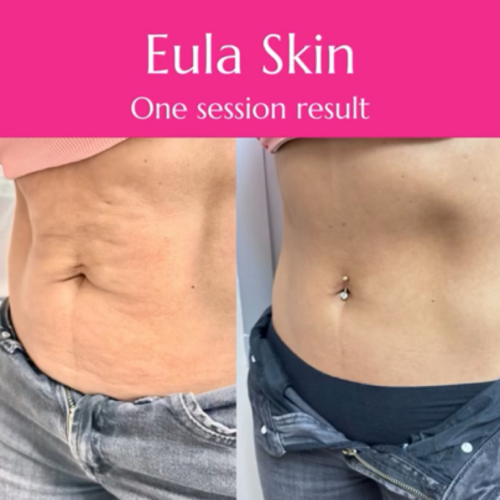 Body Cavitation + RF at Eula Skin in Dallas, TX