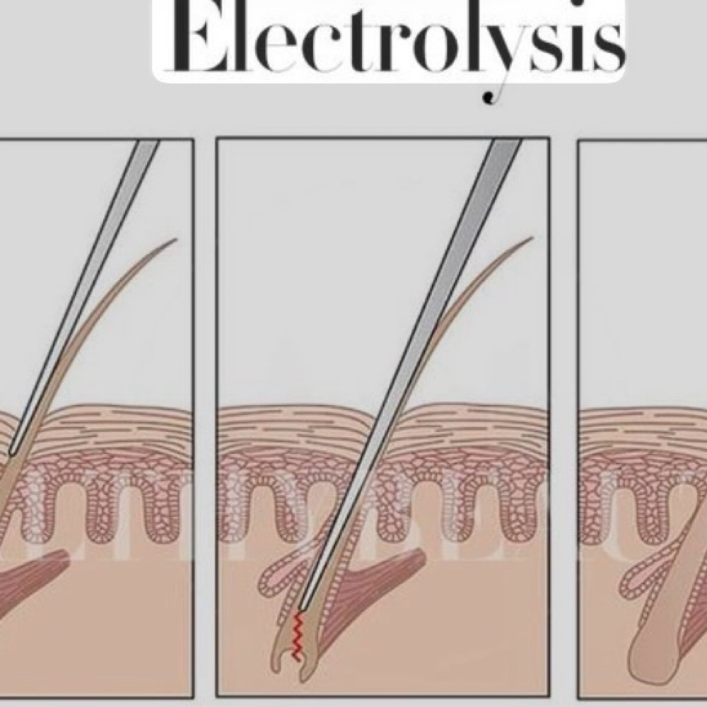 Electrolysis 30 Minutes at ForeverBeauty LLC in Leesburg, VA