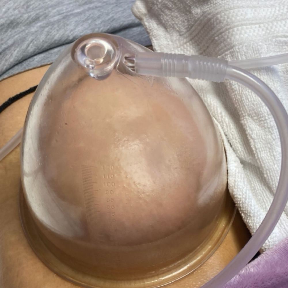 Vacuum BBL (non-invasive ) at Skin&Sculpt in Phoenix, AZ