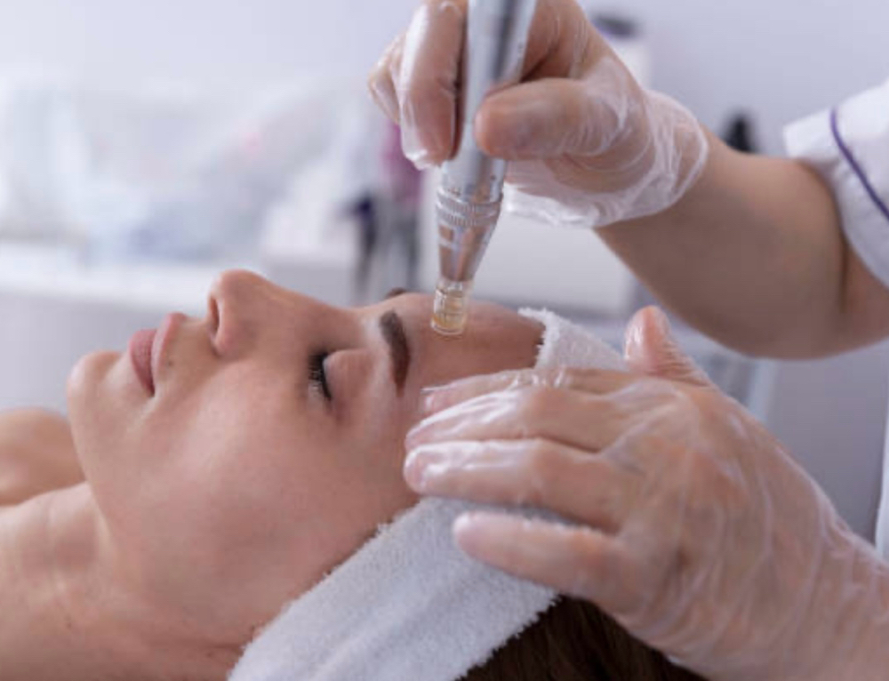 Microneedling