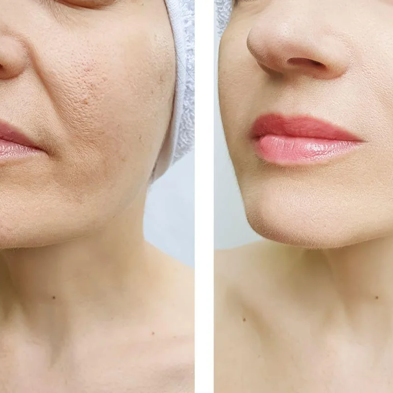 Filler Smile Lines at Gold Stone Beauty in mcallen, TX