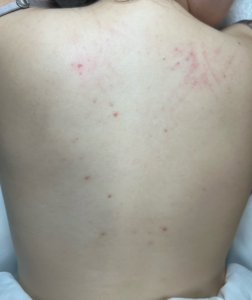 Half Back Peel at Jisell Aesthetics in Houston, TX