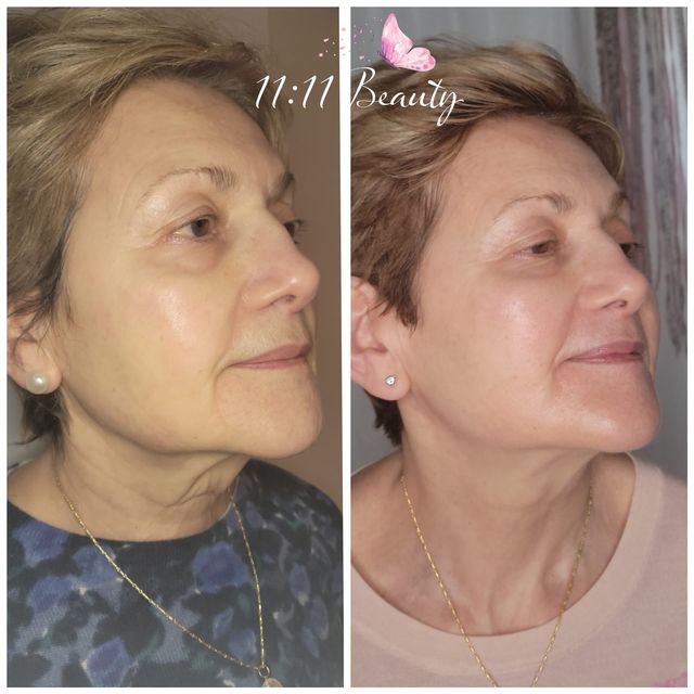 Jet Plasma Full Face Package Of 6