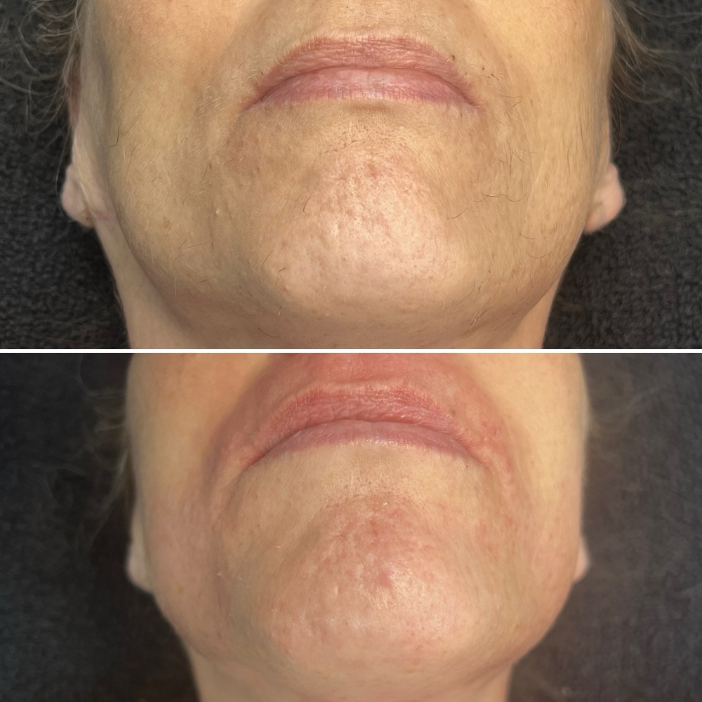 Face Waxing