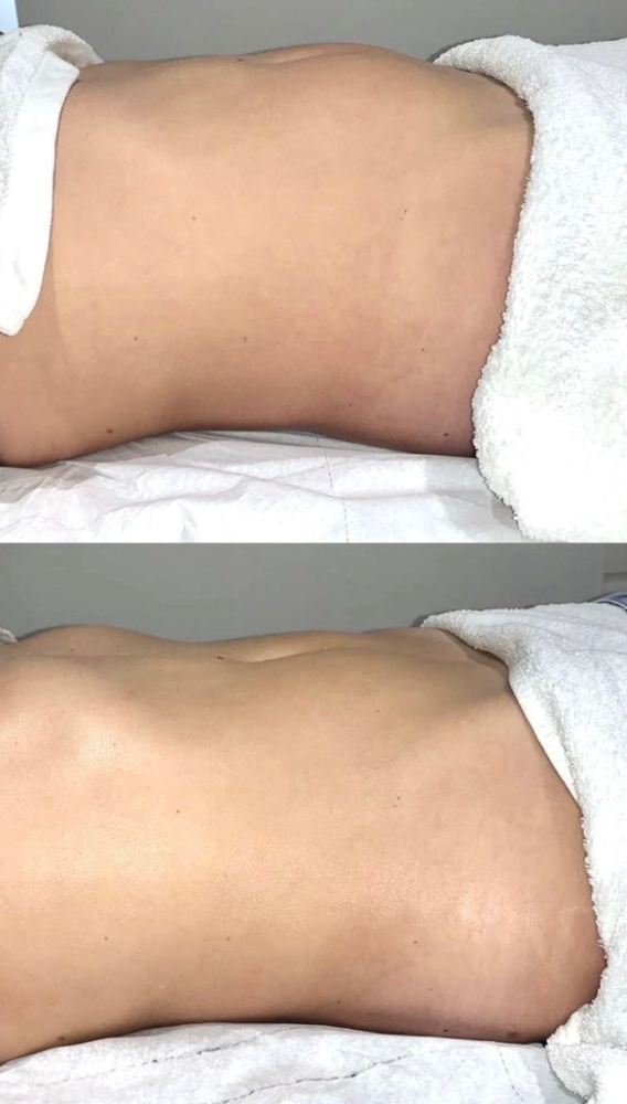 Lymphatic Drainage Therapy at Blossom Vanity Spa in Missouri City, TX