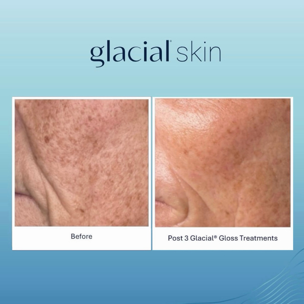 3 Glacial Gloss Treatment at SKIN CLINIC in Laguna Hills, CA