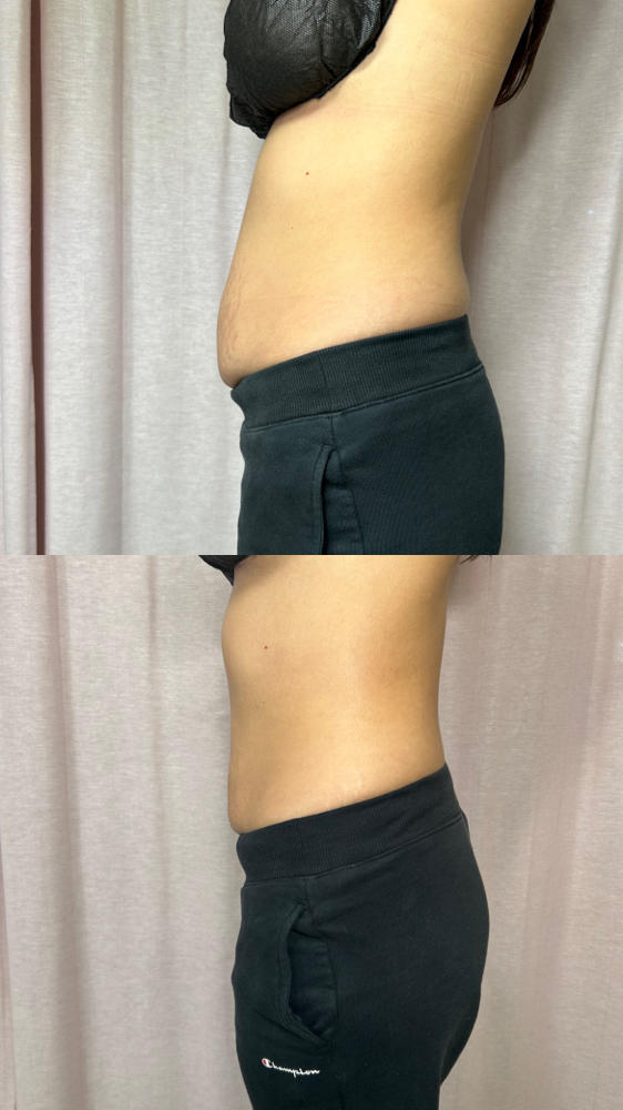 Brazilian Lymphatic Drainage 3 sess