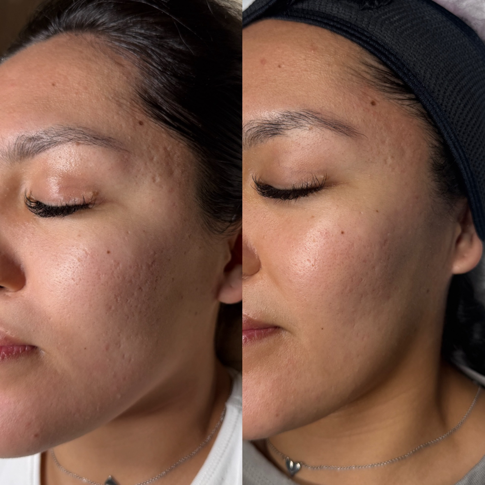 Procell Treatment at Hidden Beauty McAllen in McAllen, TX