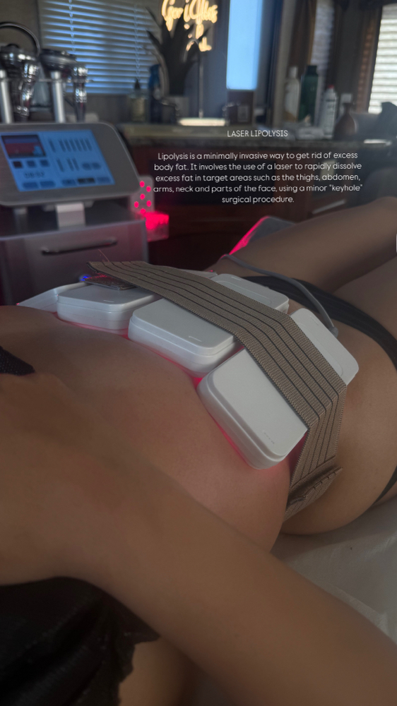 Lipo Laser