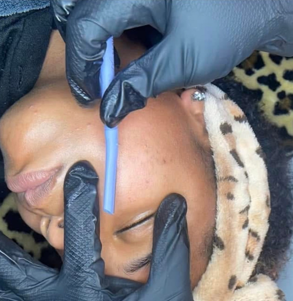 Dermaplaning Treatment