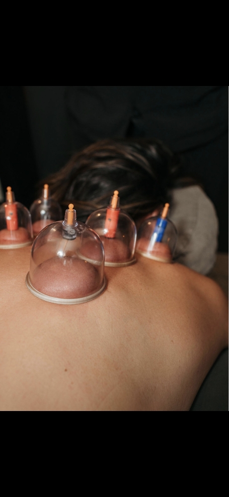 Cupping
