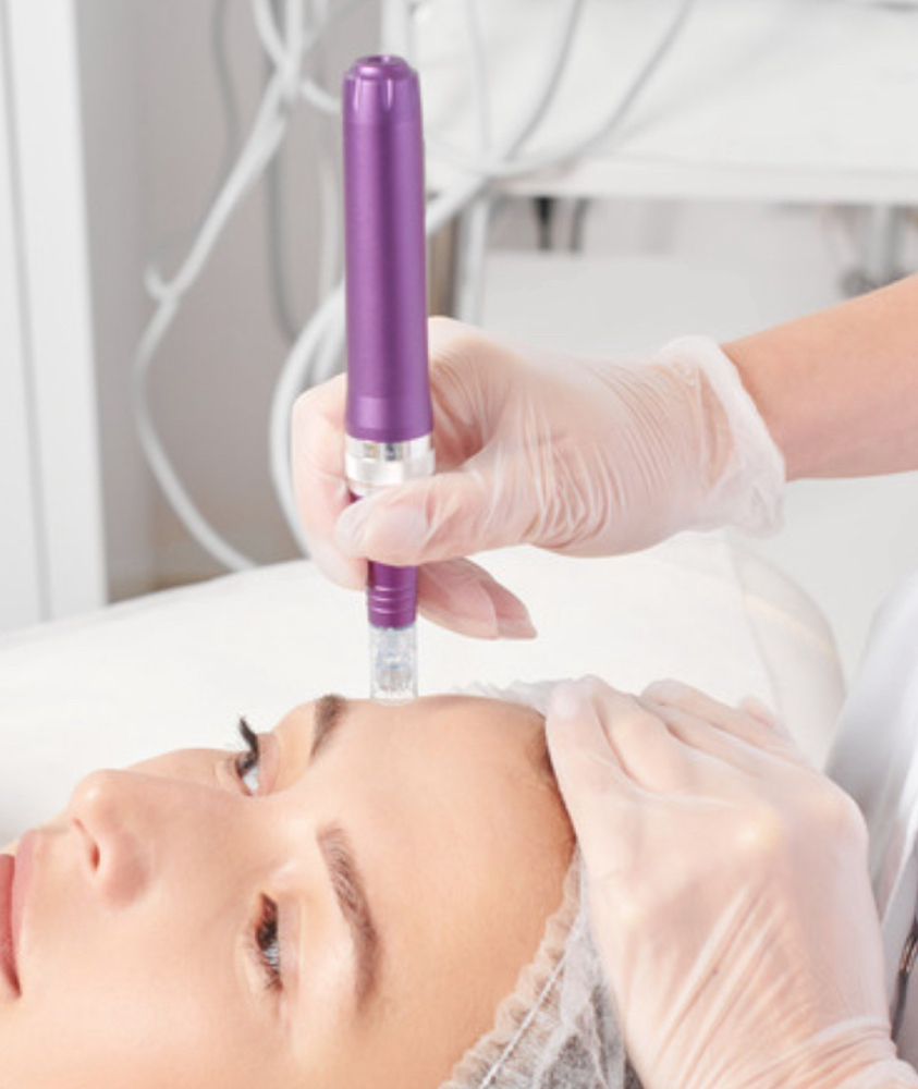 Dermal Needling ( Microneedling)