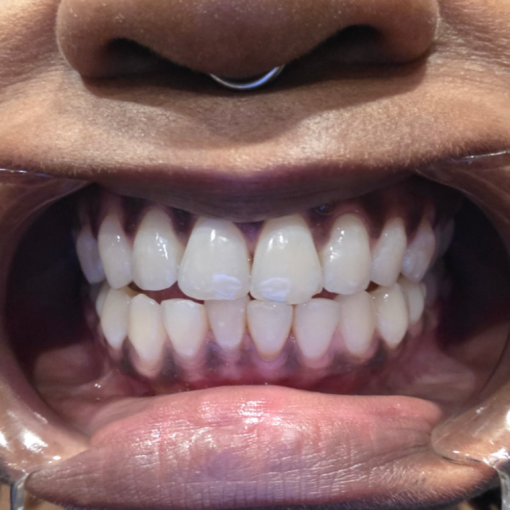 💎 DIAMOND WHITENING at Golden Luxe Aesthetics in Indianapolis, IN