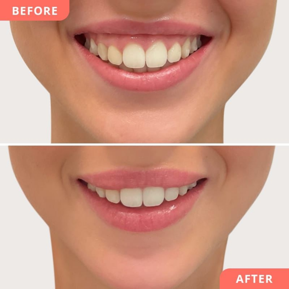 Gummy Smile Correction at Glam & Glow MedSpa in Plano, TX