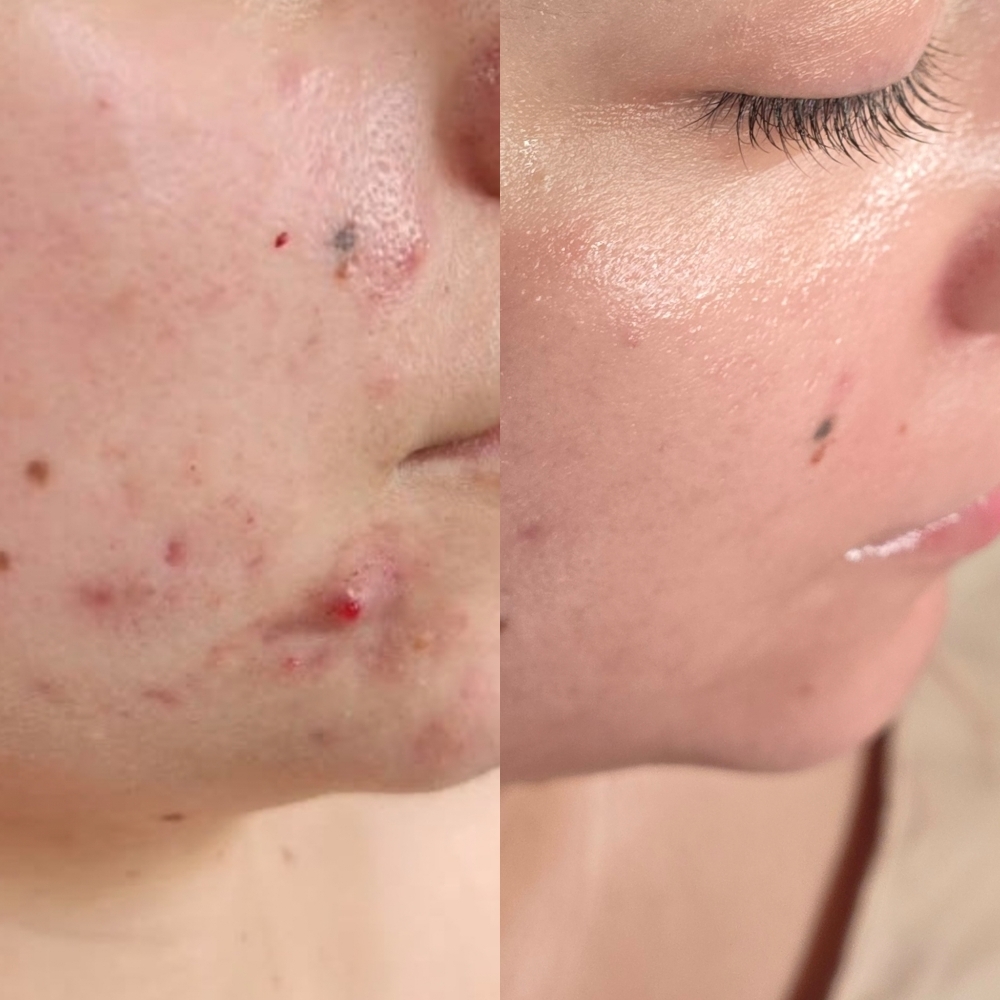 Clear Skin Journey Facial at Oregon Glow in Junction City, OR