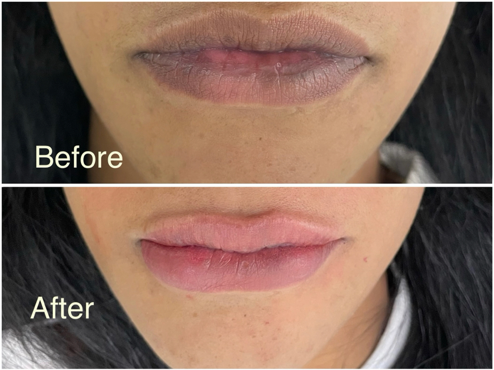 Lip Blushing
