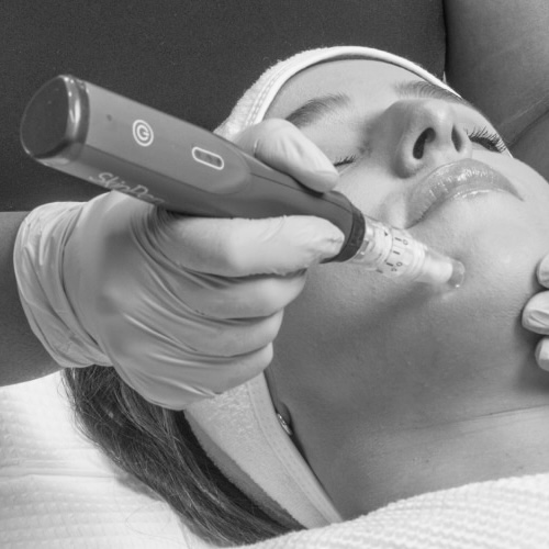 SkinPen Microneedling