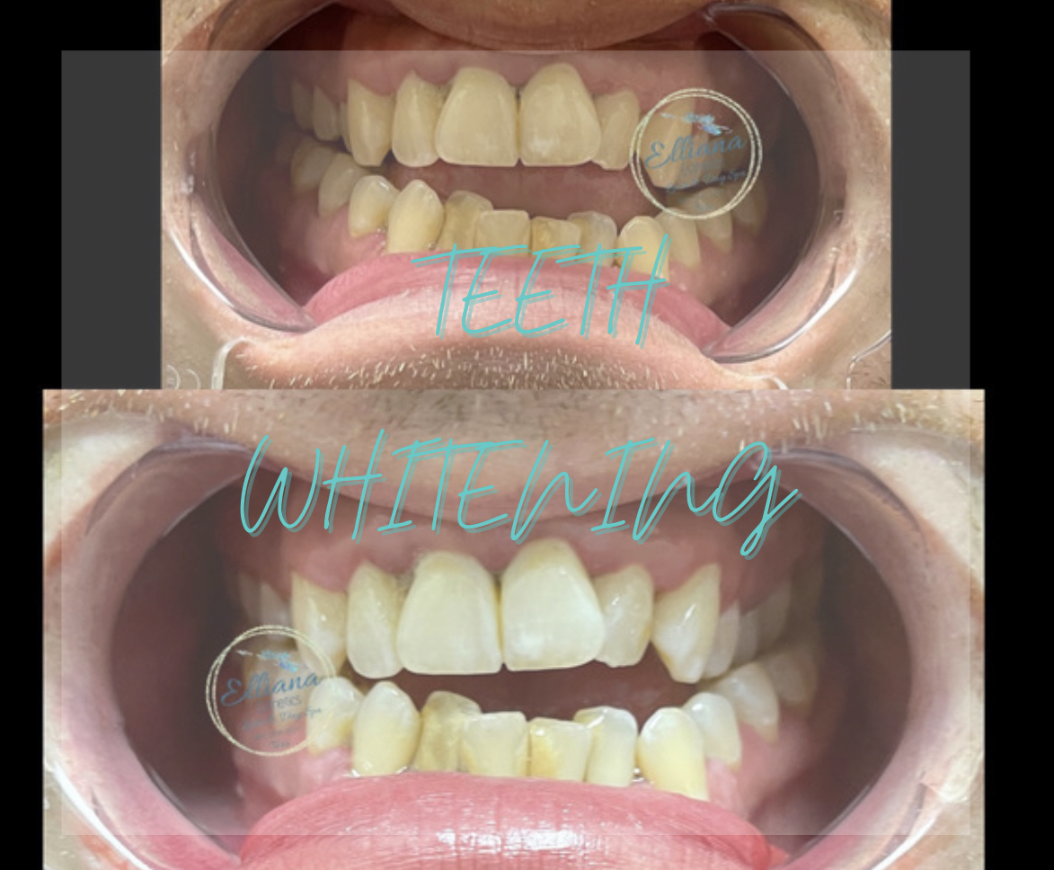 30min teeth whitening