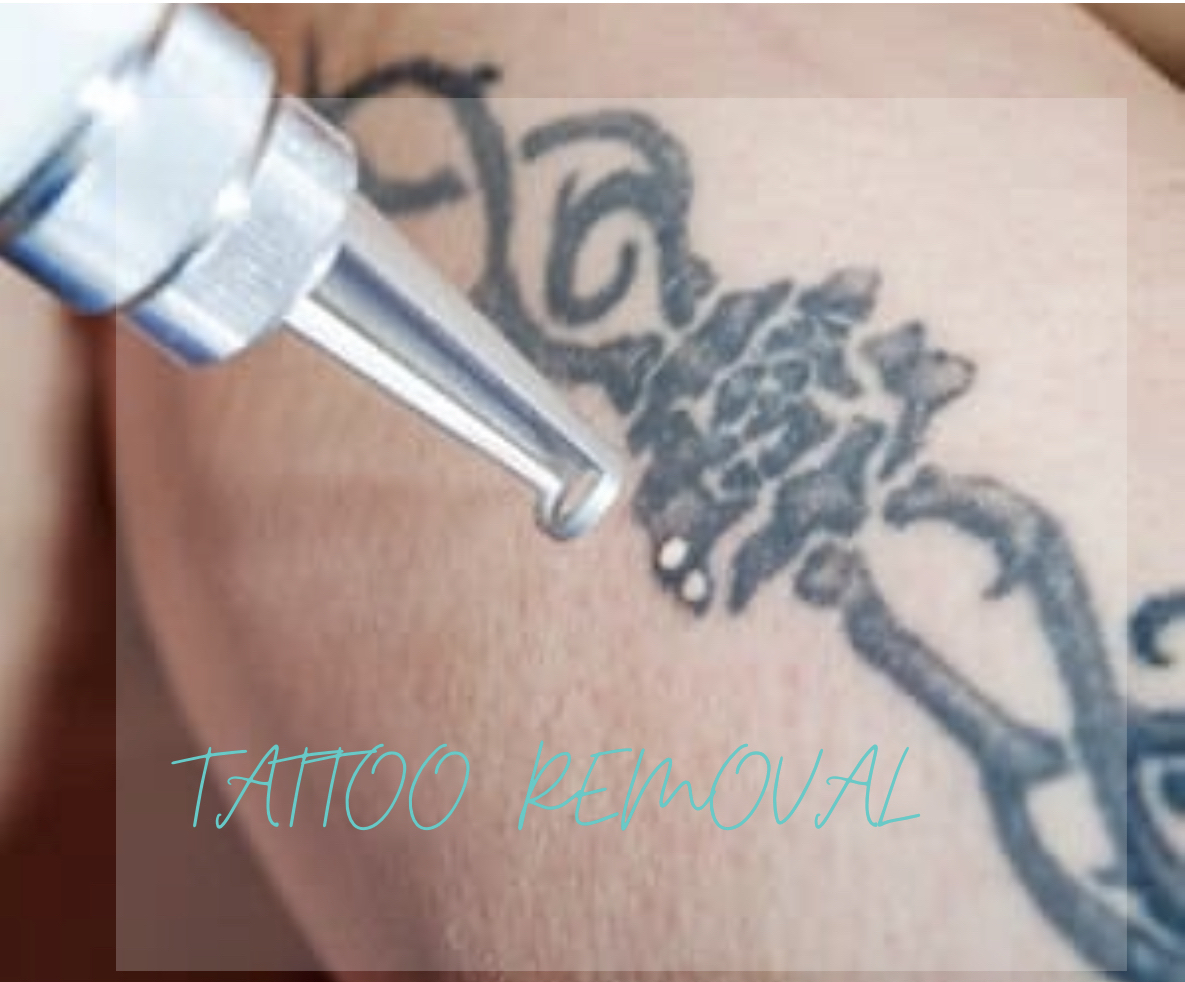 Tattoo Removal (Must Txt Pic)