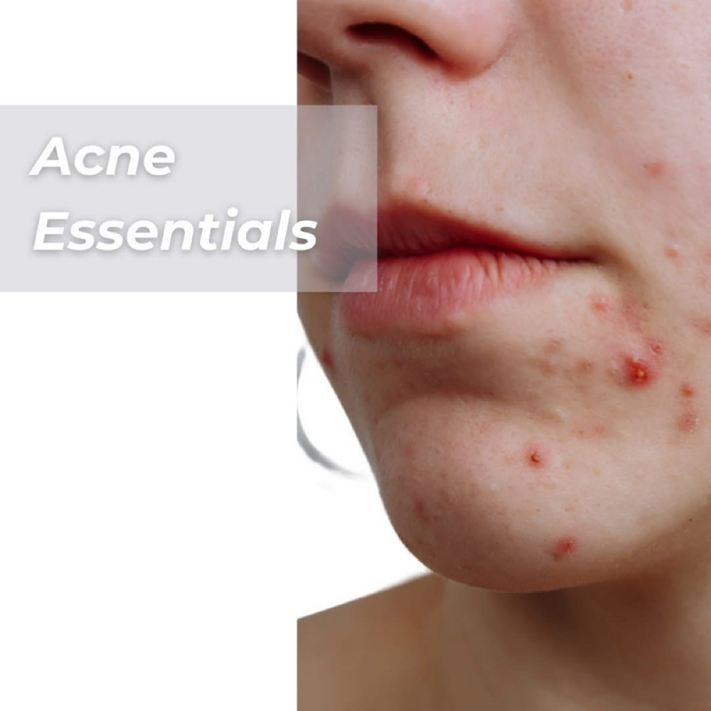 Teen Acne Treatment at Holistic Skin Center in Edgewater, FL