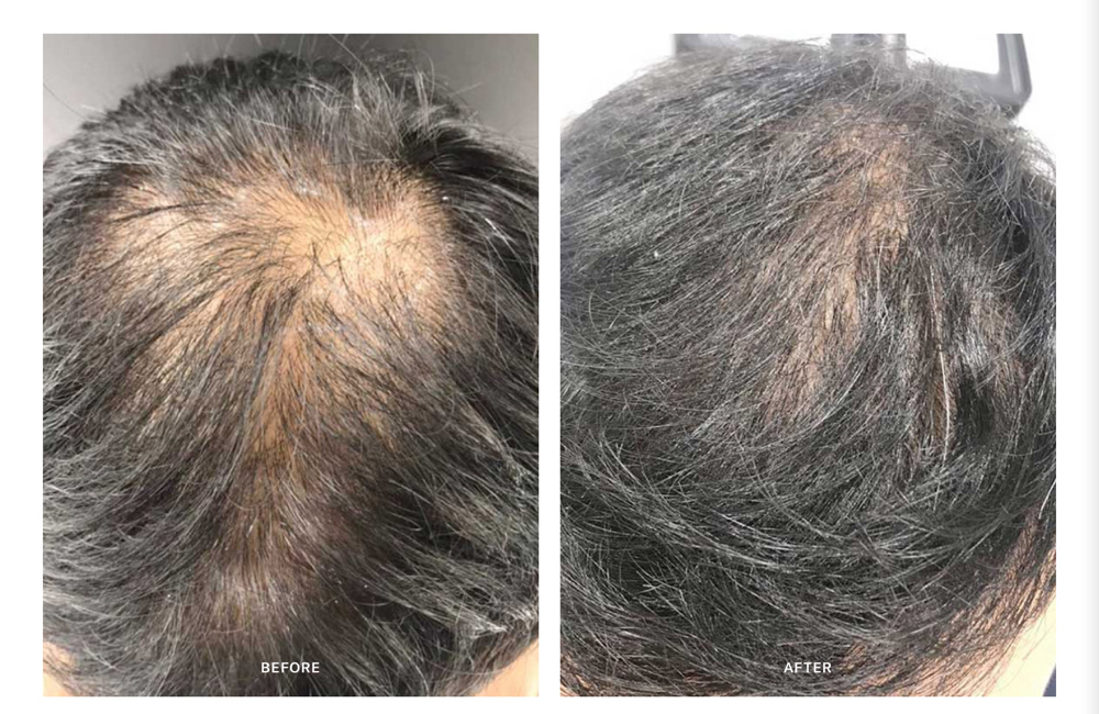 calecim Hair Loss Treatment