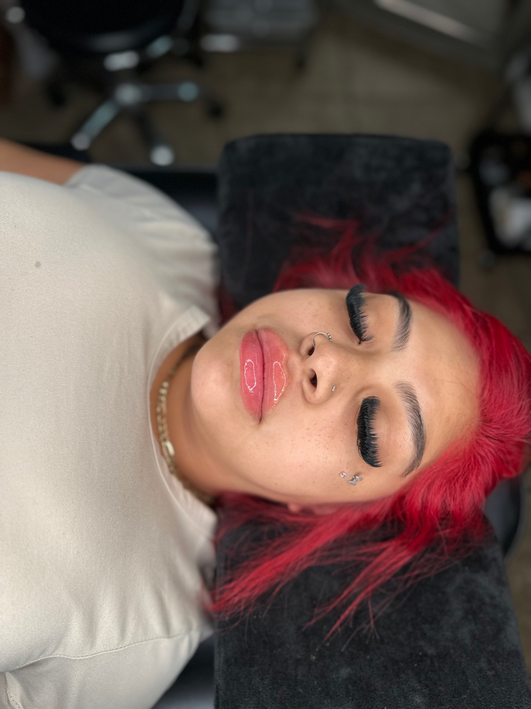 Lip filler 1.5mL