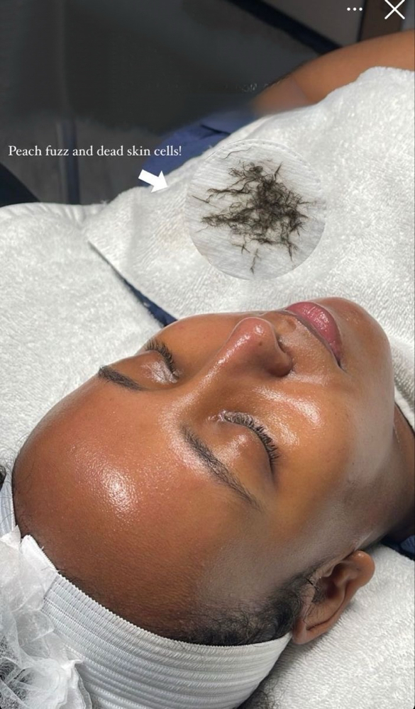 Dermaplaning Facial