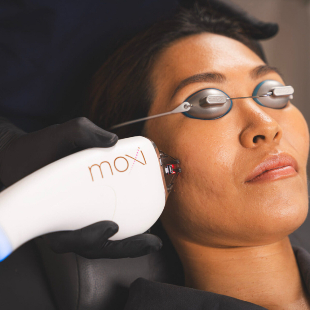 Moxi Laser Face/Neck at The Skin Concierge in Northbrook, IL