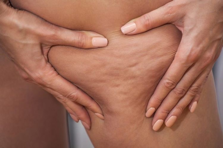 Cellulite Treatment