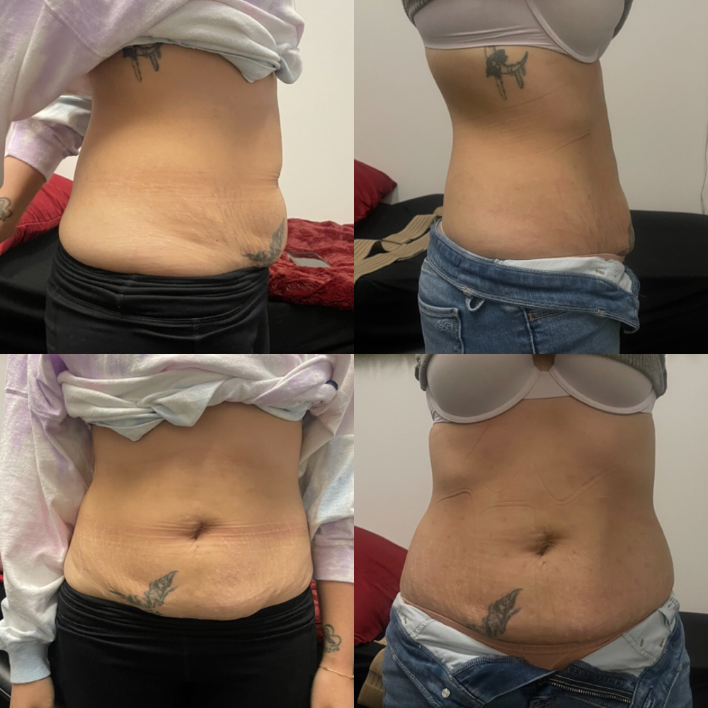 Laser Lipo  (1 Session)