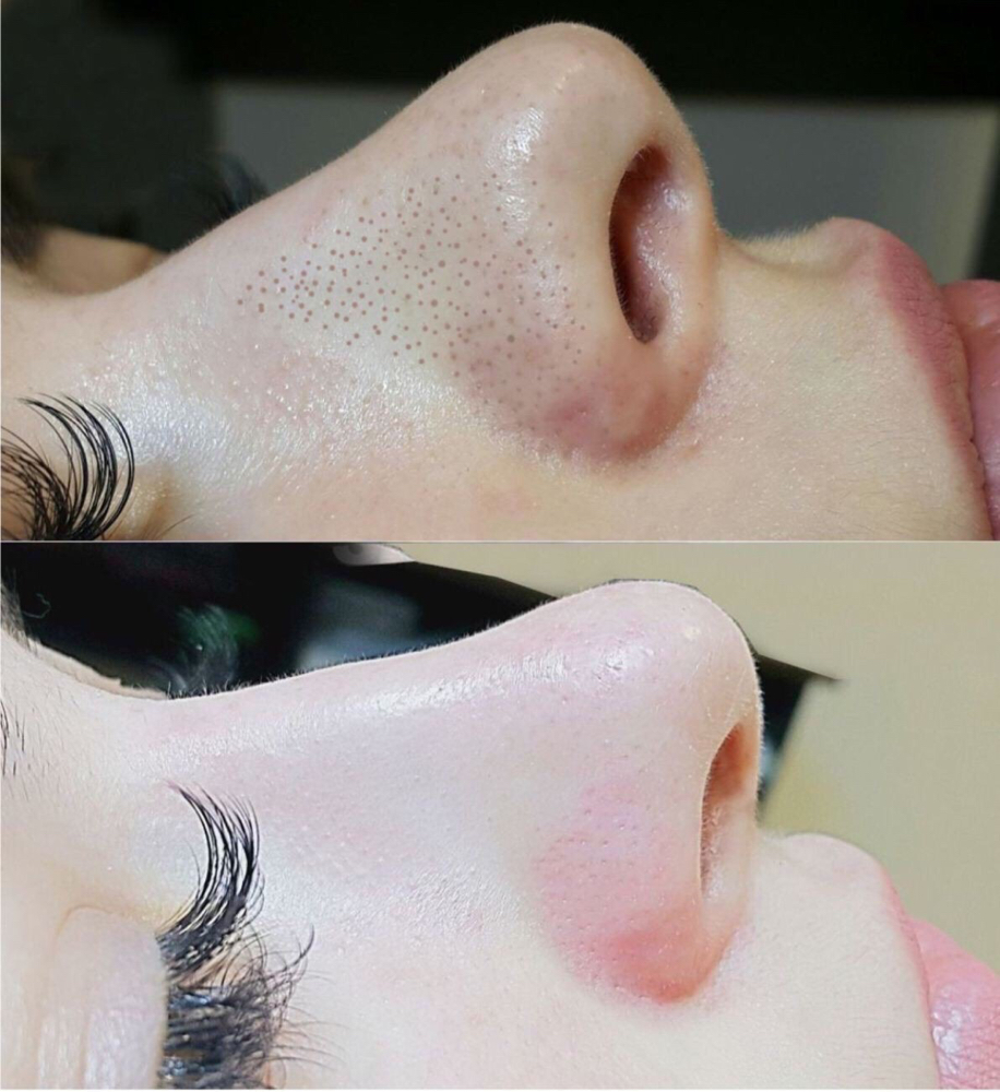 Multistage Deep Pore Cleansing