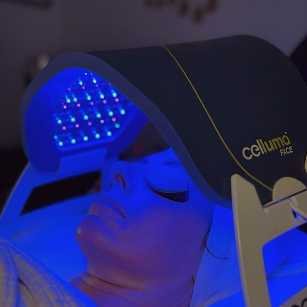 Acne Treatment at Sunrise Glow Skin in Temple, TX