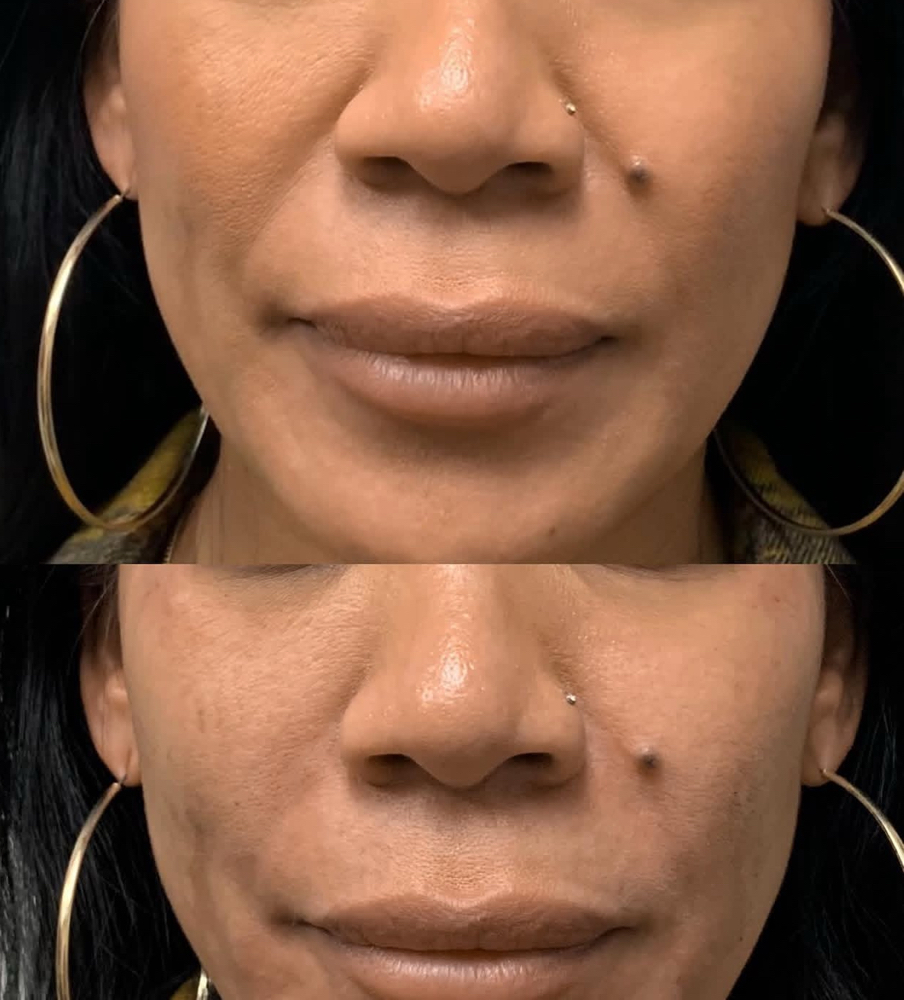 Smile lines/ Nasolabial Folds at Perfection Injections in Euless, TX