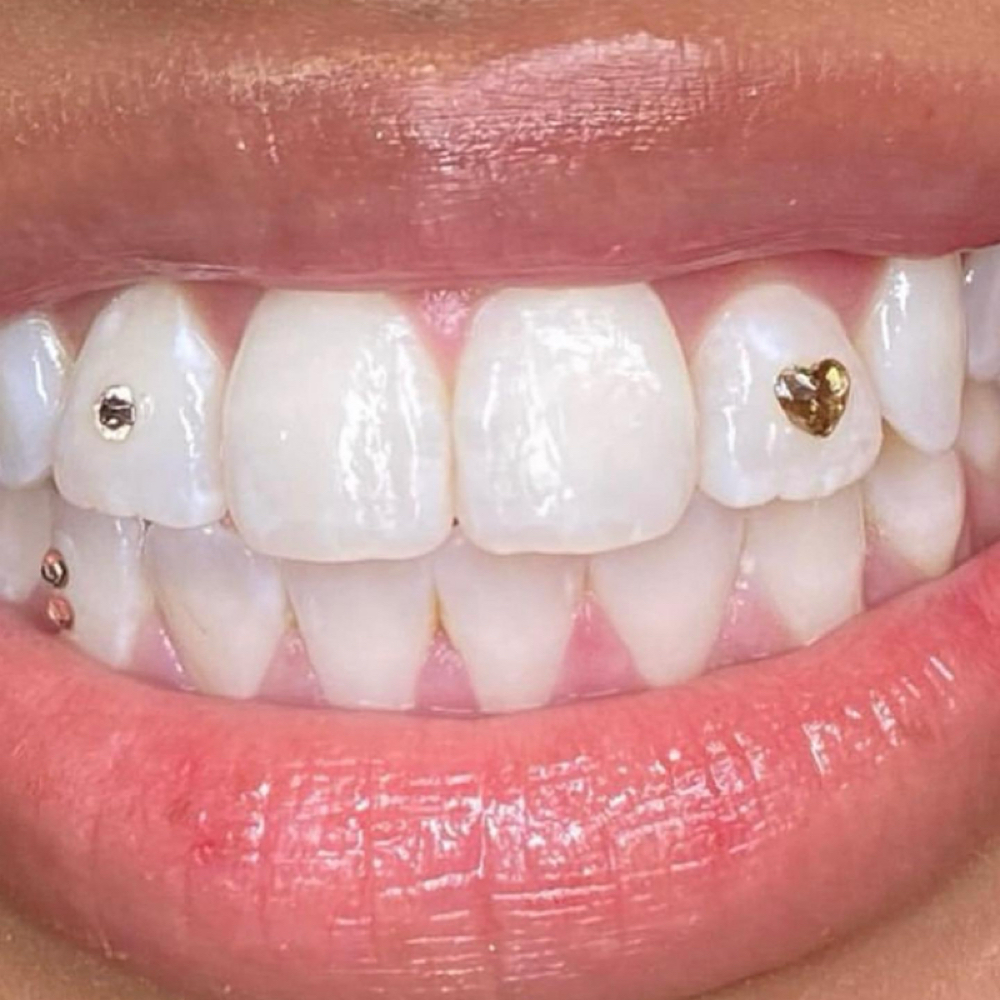 3 Gem Package at Shaqs Teeth Whitening in Tarboro, NC
