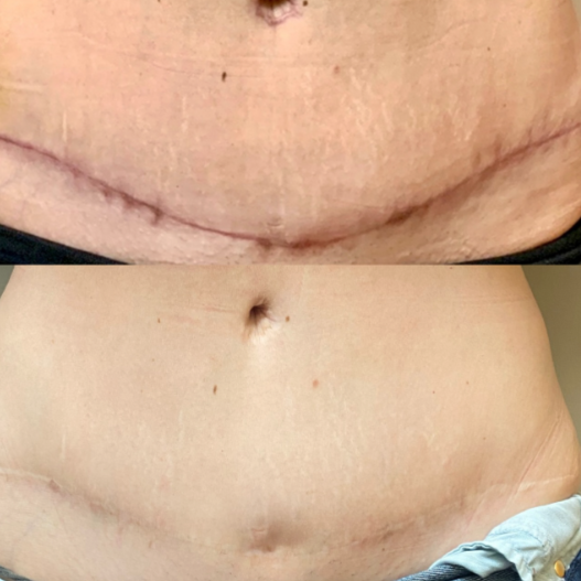 Stretch Mark & Scar Repair at Beyond The Scar in Leander, TX