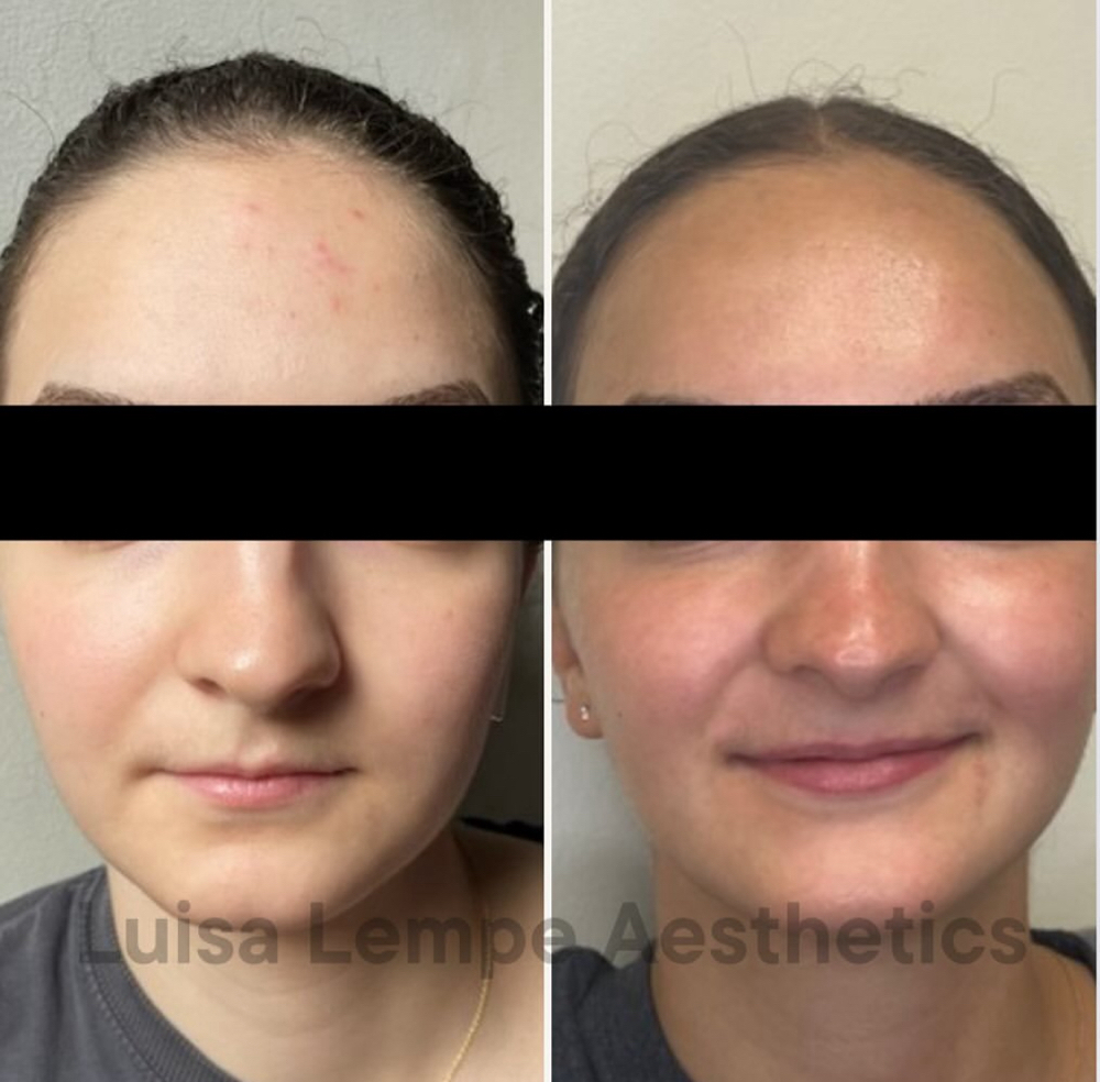 Acne Bootcamp Package