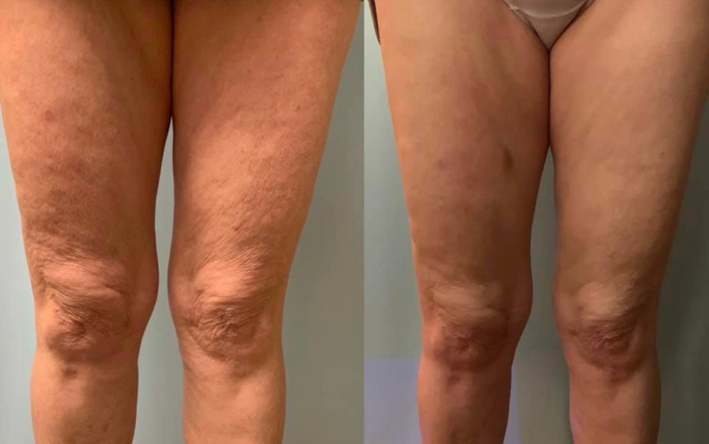 Cryoskin Thigh Slimming