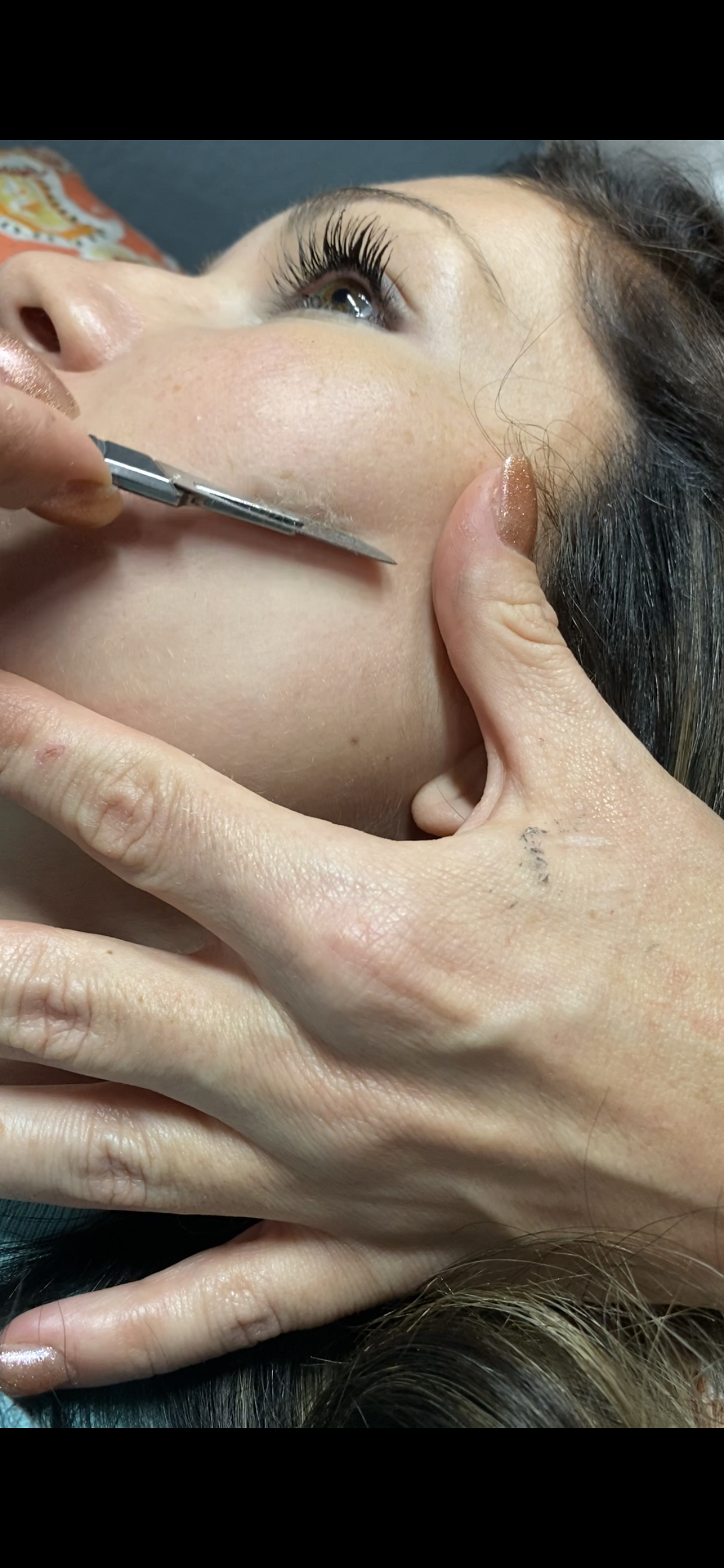 Dermaplanning