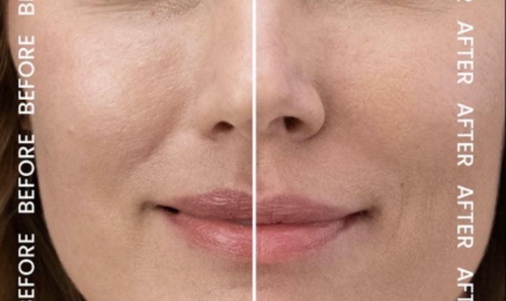 Dermal Filler-Nasolabial/Mouth