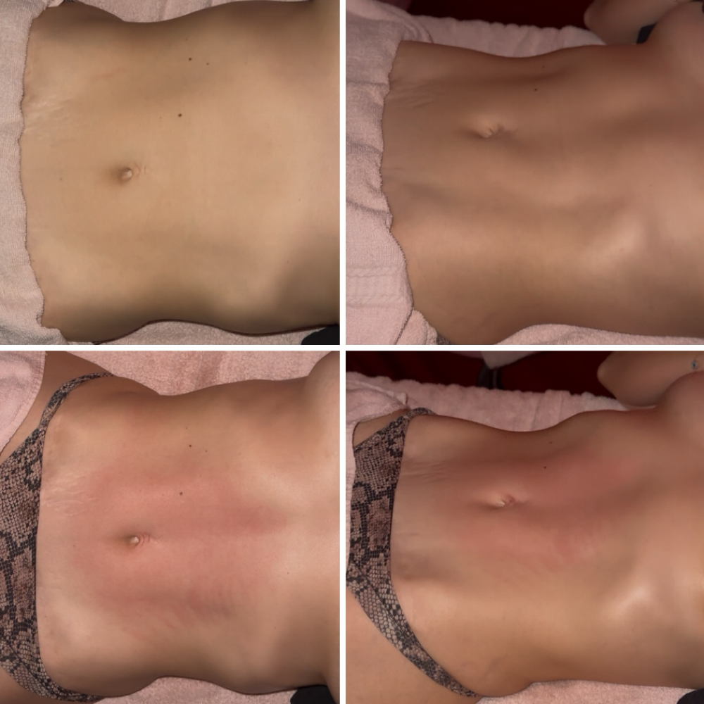 LUXE Post Op Treatment at Sculpted by Lluvia in Weslaco, TX