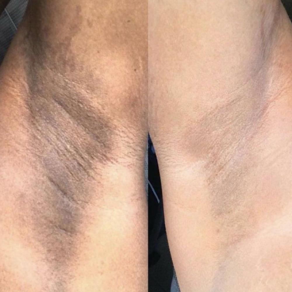 Skin Lightening Small Area at Glow With Beauty LLC in Bristol, CT