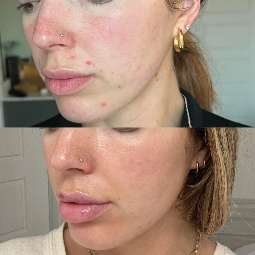 Acne Clear + Renew Facial