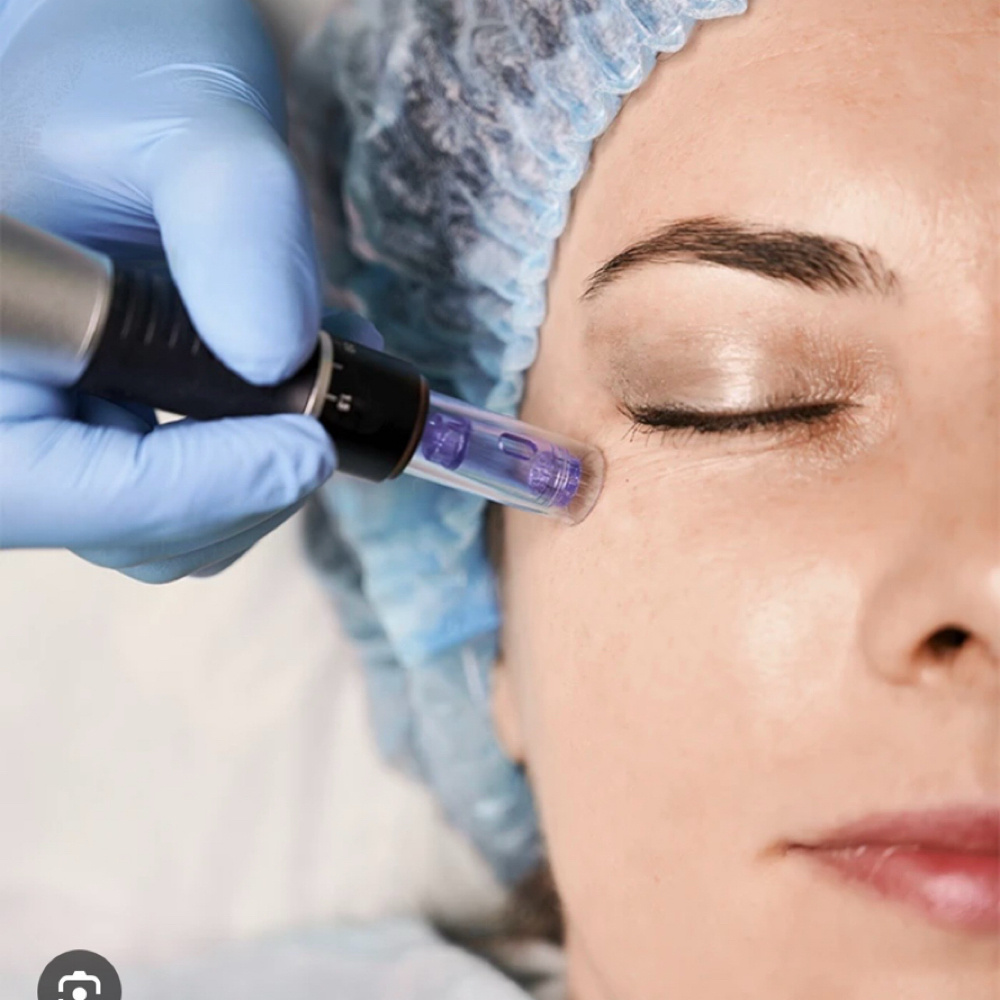 MicroNeedling, Facial, Enzyme Peel