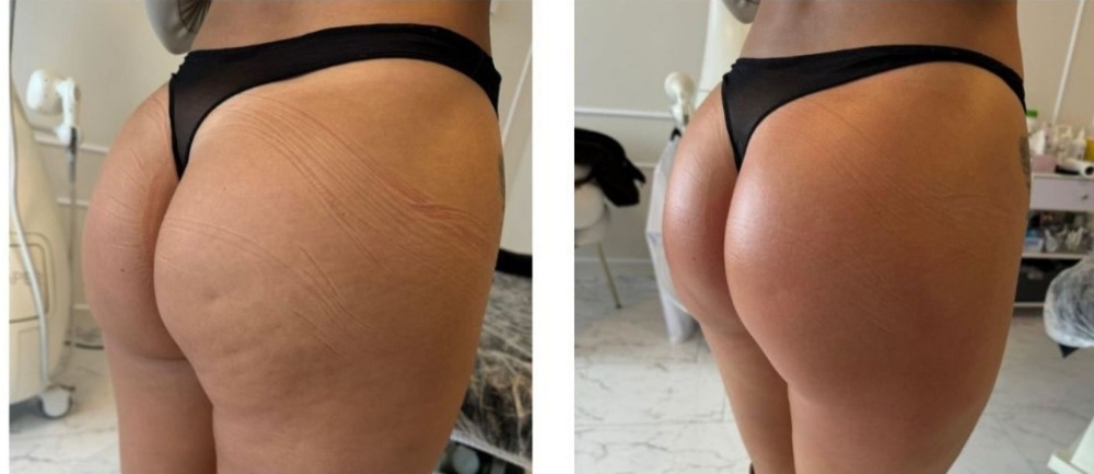 legs and butt lift at cryo Body Contour in Riverdale, GA